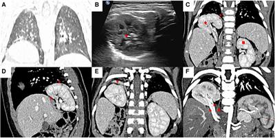 Case Report: Thoracoscopic treatment of infradiaphragmatic pulmonary sequestration and intrathoracic kidney associated with congenital diaphragmatic hernia